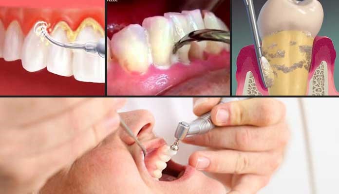 روشهای پیشگیری و درمان تحلیل لثه