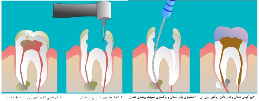 درمان مرگ دندان