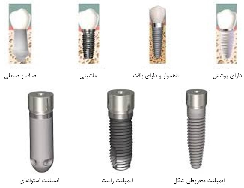 انواع ایمپلنت
